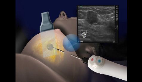 tasmania sex freezing breast tumors