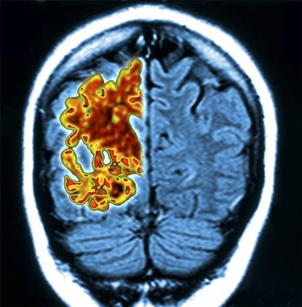 Alzheimer's 'lost' Memories May Be Recoverable: Study - I24NEWS