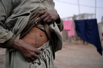 Un Pakistanais dans le besoin montre sa cicatrice après s'être fait prélever un rein pour le vendre