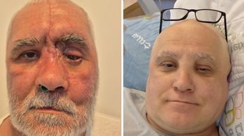 Roman before and after the surgery. 