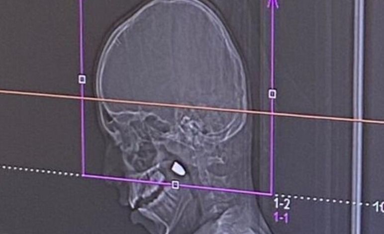 معجزة طبية: أطباء رامبام ينقذون طفلا عربيا أُصيب برصاصة طائشة في رأسه