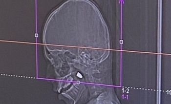 محاكاة للرصاصة التي استقرت في رأس الطفل خلال احتفالات رأس السنة الجديدة