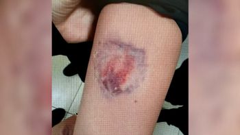 השוטרת שננשכה על ידי אישה בשכונת גילה בירושלים, 17.12.25