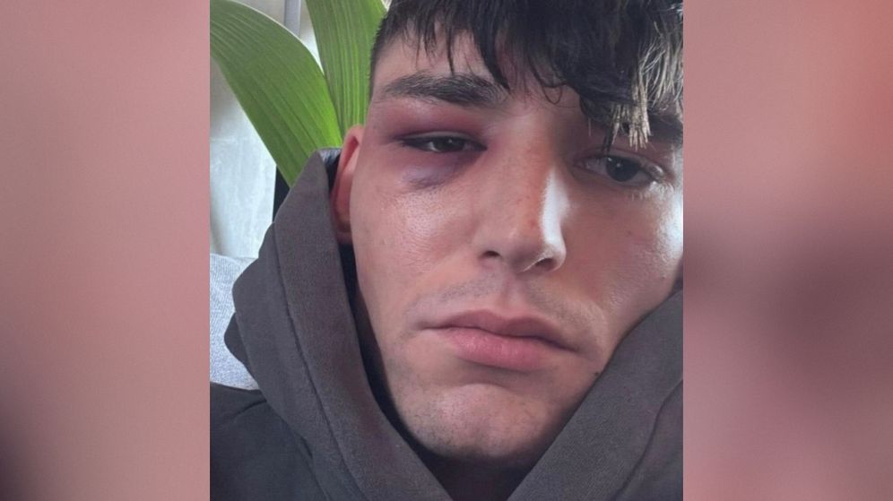 שופט הכדורגל הגרמני פסקל קייזר לאחר שהותקף בביתו